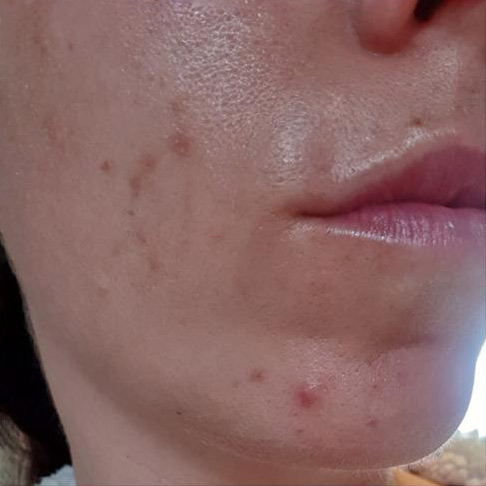 Chemical Peel Before 1 Chemical Peel Before 1