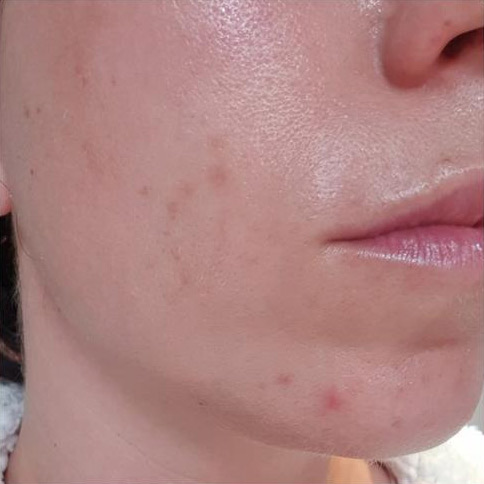 Chemical Peel After 1 Chemical Peel After 1