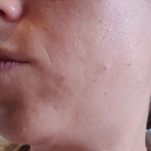 Chemical Peel Before 2 Chemical Peel Before 2
