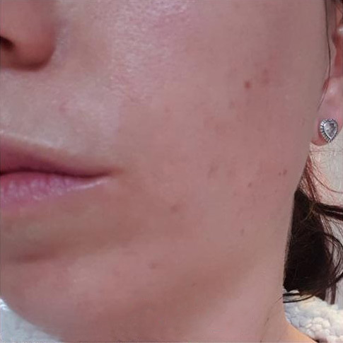 Chemical Peel After 2 Chemical Peel After 2