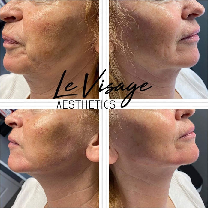Le Visage Before and After Results Gallery Le Visage Before and After Results Gallery